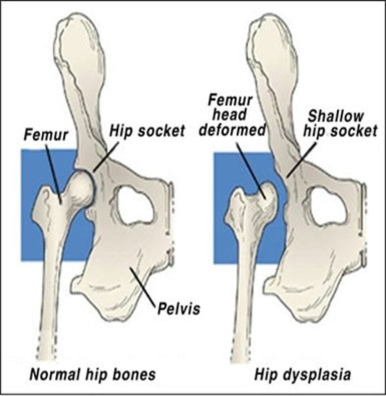 Hip Dysplasia