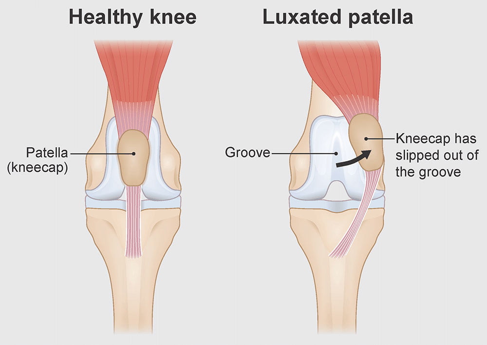 Patella Luxation